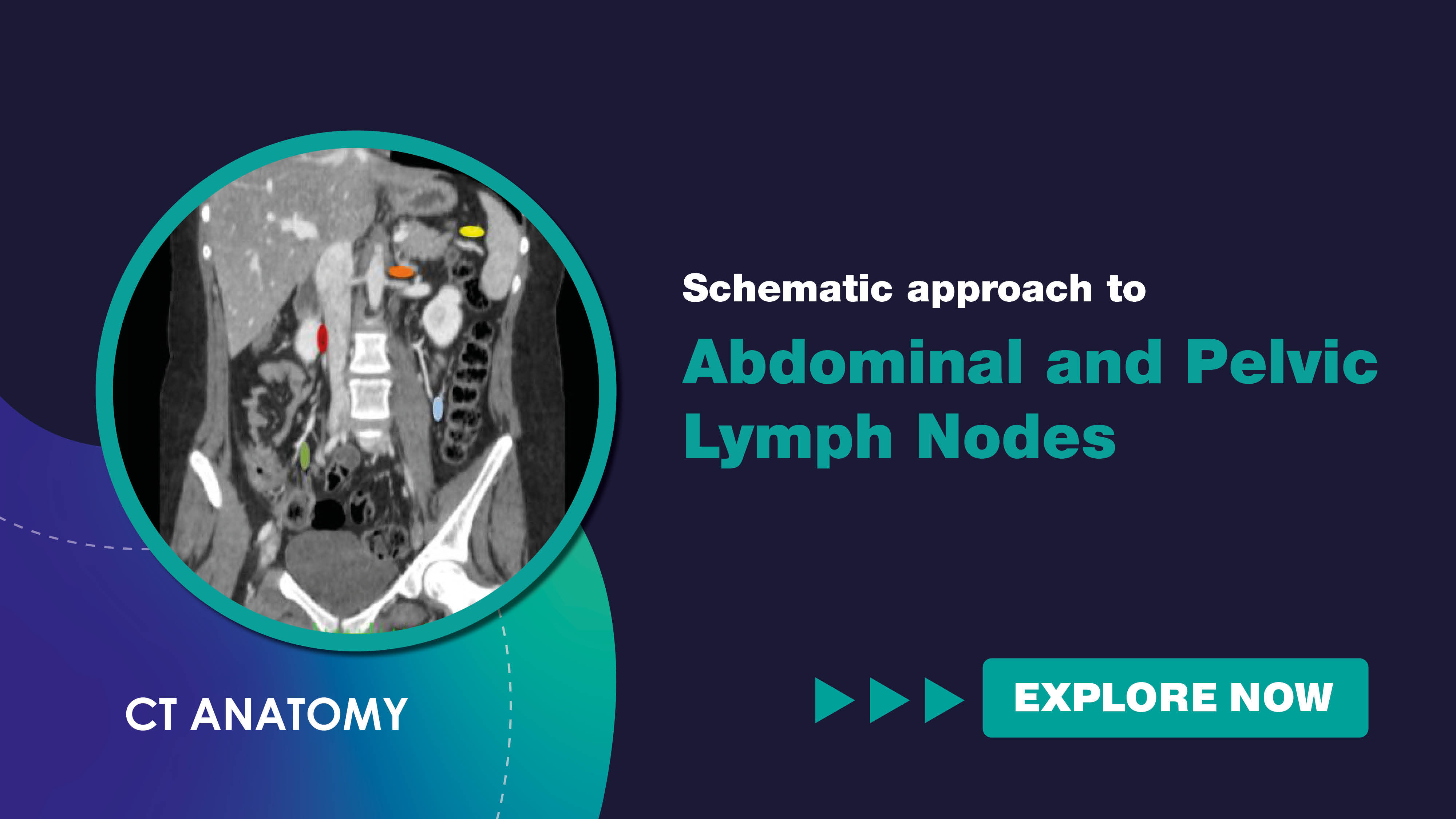 schematicapproachtoabdominalandpelviclymphnodes.jpg