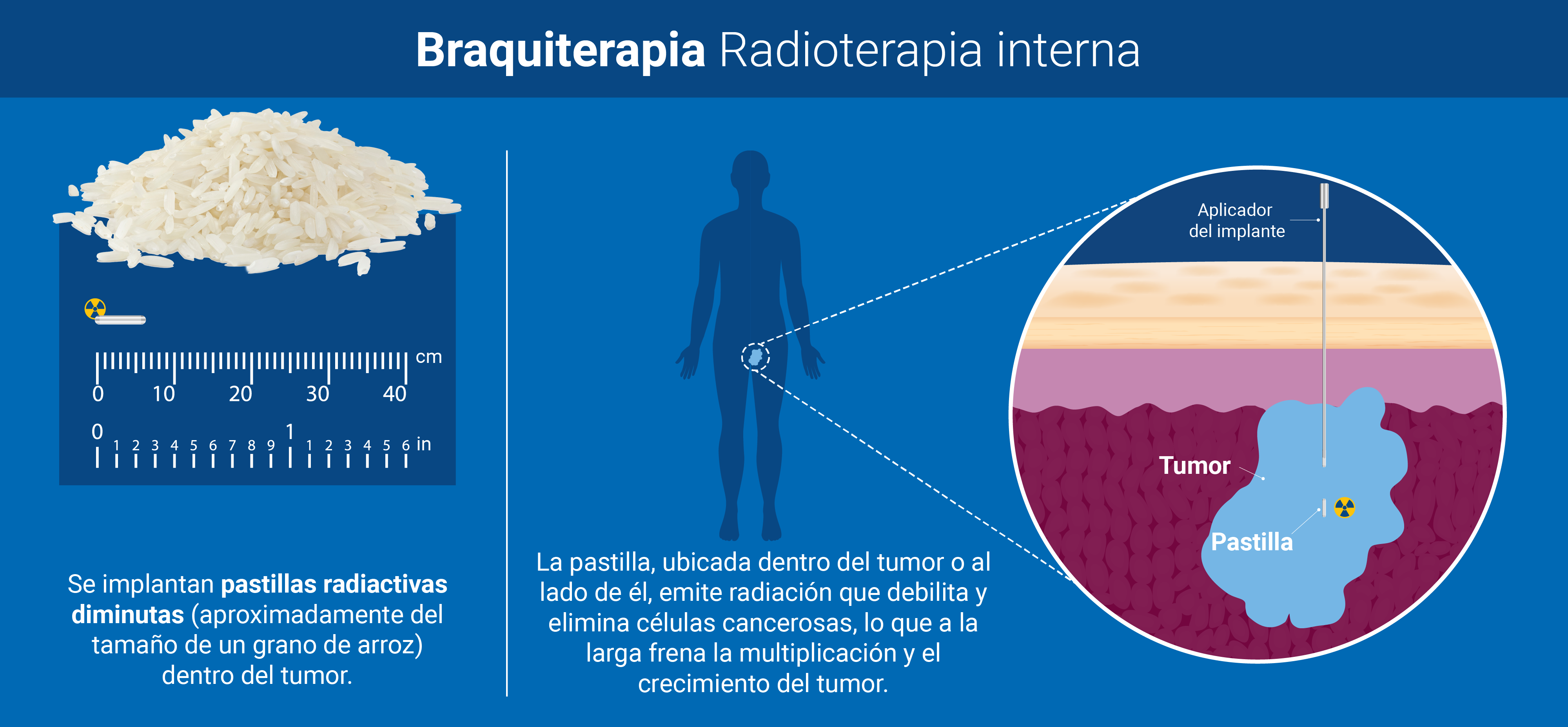 radioterapia_interna.png