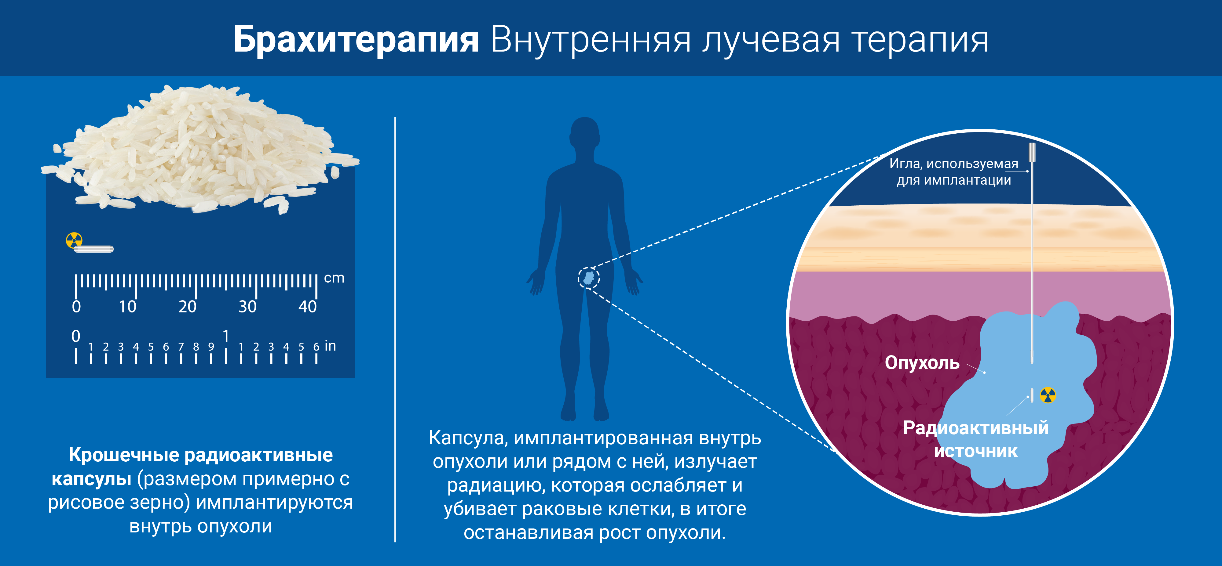 radiotherapy_v3_sp_-_copy_brachytherapy.png