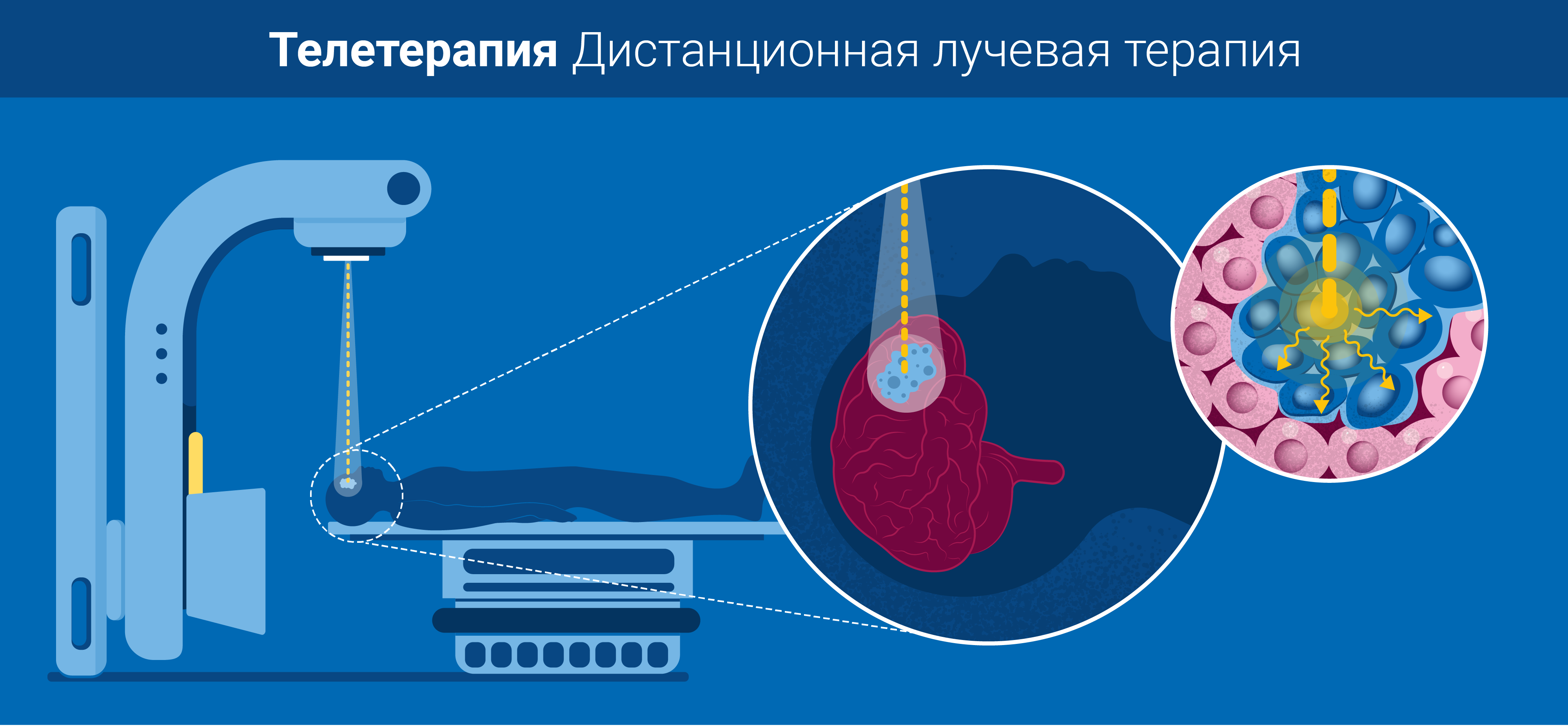 radiotherapy_v3_sp_-_copy_teletherapy.png