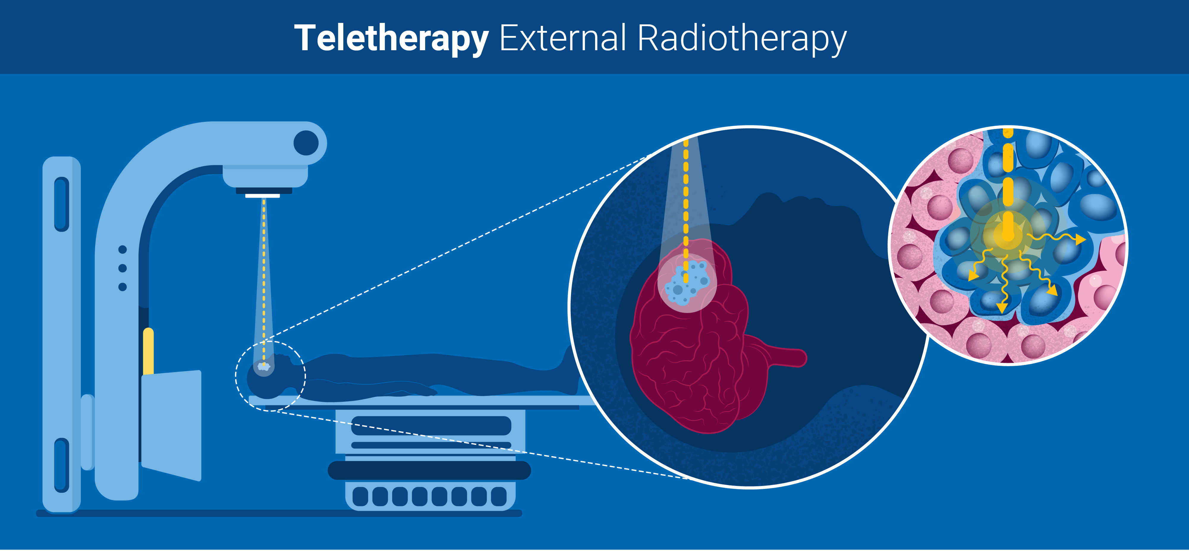 radiotherapy_v3_teletherapy.jpg
