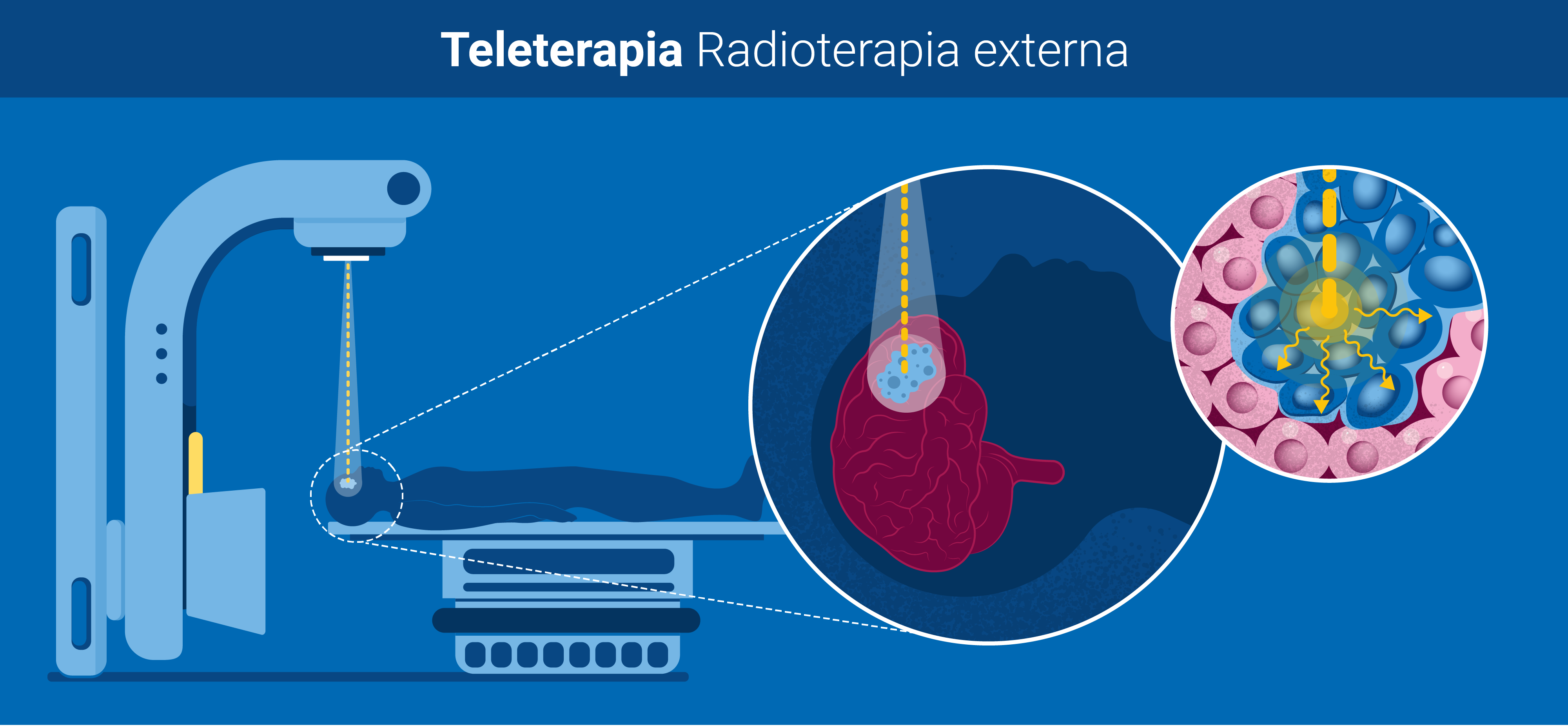 teleterapia_radioterapia_externa.png